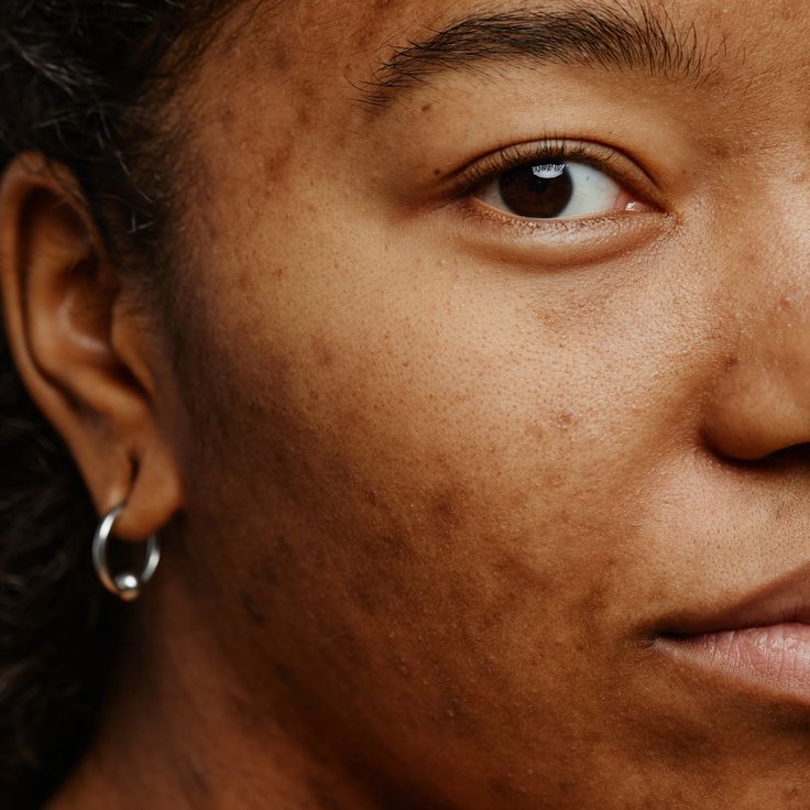 Hyperpigmentation
